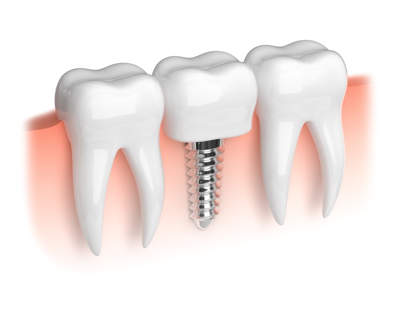 Why Composite Dental Fillings are the Modern Choice in Chicago