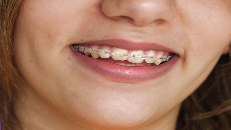 The Specifics of Dental Bridges in Oak Brook, IL